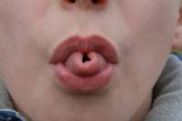 Phénotype de la langue en gouttière (vue 1) : un caractère  mendélien ?